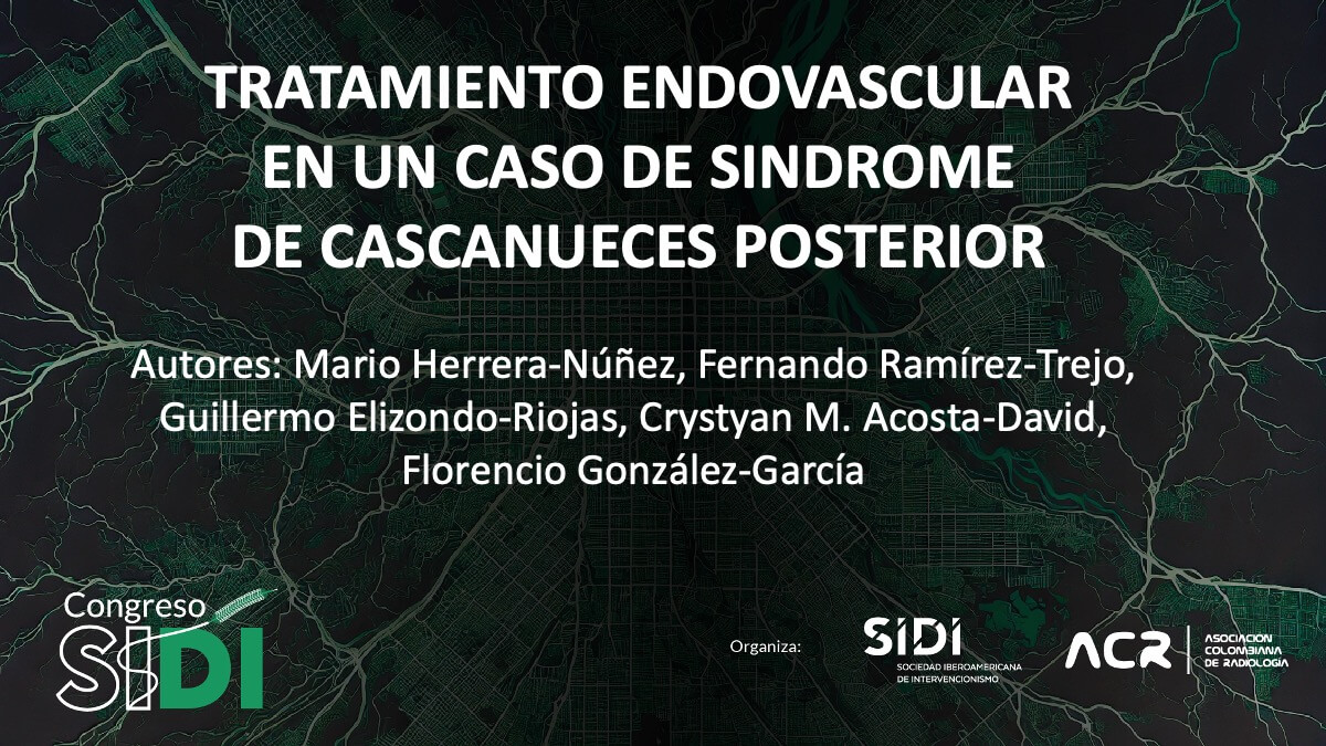 Tratamiento endovascular en un caso de síndrome de cascanueces posterior